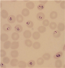 Bild på Plasmodium-infekterade röda blodkroppar (malaria)