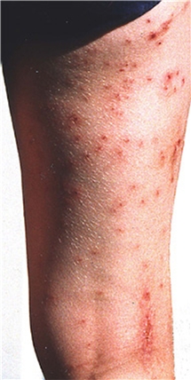 Bild på ben med Cerkariedermatit (badklåda).