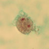 Mikroskopbild på Dientamoeba fragilis trofozoit.