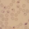 Mikroskopbild på Plasmodium-infekterade röda blodkroppar (malaria).